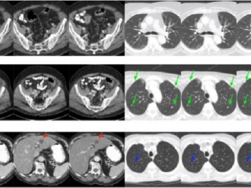 Machine Learning Approach For Low Dose Ct Imaging Yields Superior